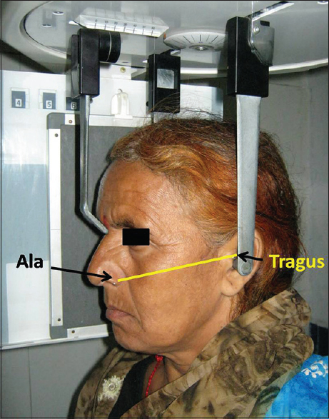 Figure 1:  Locating the ala-tragus plane in natural head position