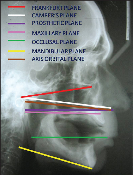 Figure 2: Various anatomic reference planes marked over the lateral cephalogram