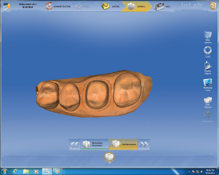 Figure 1: Virtual model from CEREC inEos X5 scanning