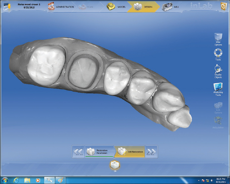 Figure 3: Virtual model from CEREC Bluecam scanning