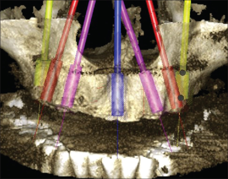 Figure 1: Three dimensional view of seven virtual implants planned in edentulous maxilla using cone beam computed tomography (ProMax3DMid ProFace, Planmeca Inc., IL, USA)