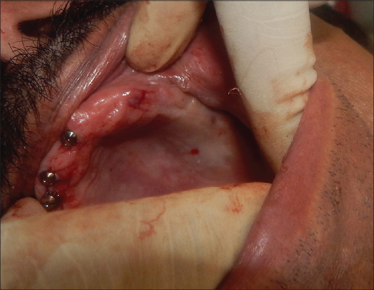 Figure 3: I-shaped incision to expose the implant cover screw during second stage surgery