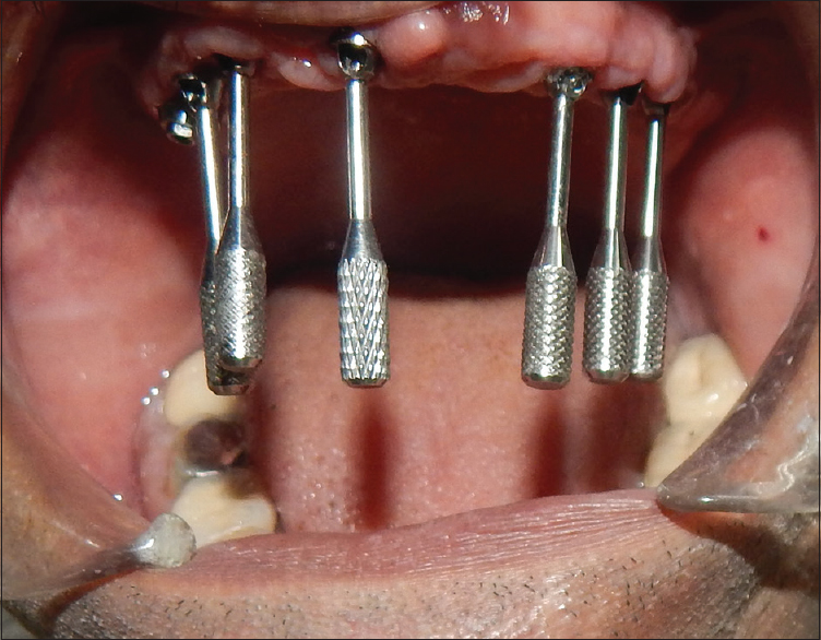 Figure 4: Abutment holder attached to the multi-unit straight and angulated abutments