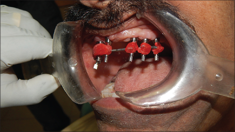 Figure 5: Open tray impression copings splinted using worn-out dental burs and reinforced with autopolymerizing resin