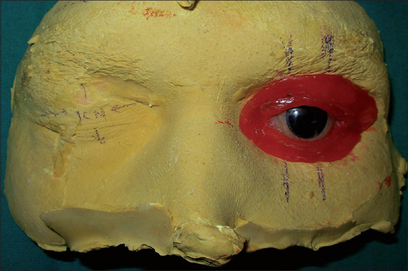 Figure 2: Facial moulage