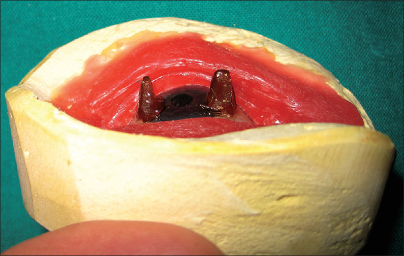 Figure 4: Modification of stock ocular conformer using sticky wax