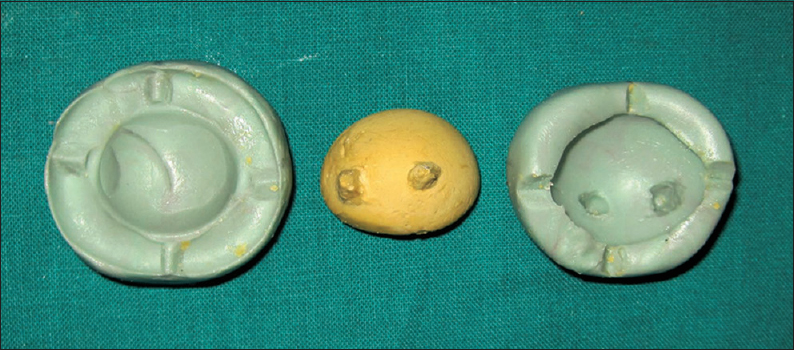 Figure 7: Formation of die stone replica of conformer-sticky wax assembly