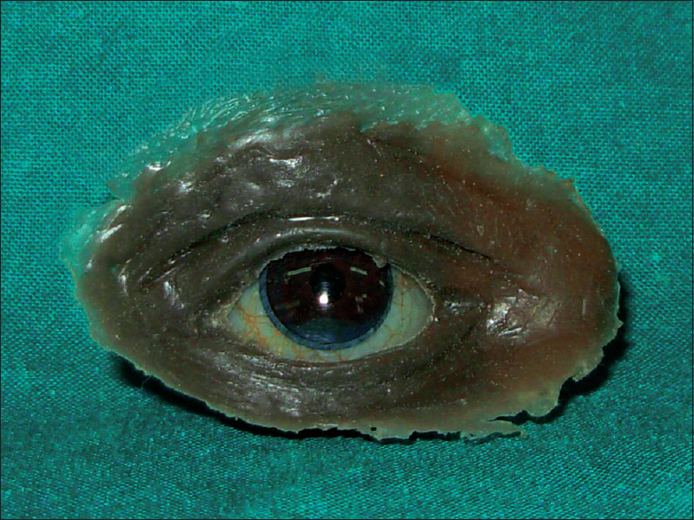 Figure 9: Final prosthesis. The ocular conformer was inserted in prosthesis after deflasking procedure