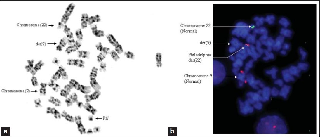 Figure 2: (a) Partial metaphase showing Ph? chromosomes der(22) and der(9). (b) FISH with the dual fusion probe showing BCR/ABL fusion on chromosome 22 and the absence of ABL/BCR on the der(9) chromosome