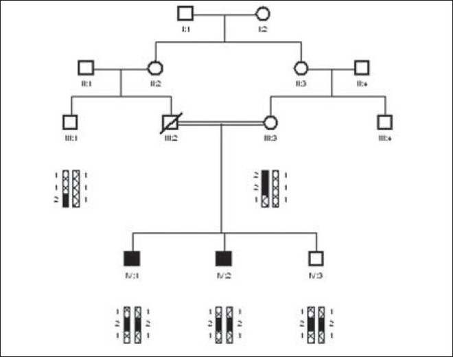 Figure 1: Pedigree of family MR-05. The three STR markers D4S191, D4S2392, and D4S3024 in candidate region of mental retardation locus MRT1 gene PRSS12 showed potential linkage. Mental retardation phenotype in this family was potentially linked to mental retardation locus MRT1 gene PRSS12