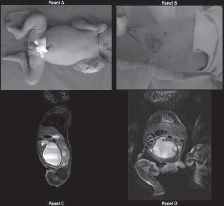 Figure 2: Panel A shows a large lower abdominal mass at birth (hydrometrocolpos). Panel B report reduction of abdominal mass after fluid drainage. Panel C and D report abdominal MRI (sag. and cor T2 w) shows large abdominal cystic mass communicating with endometrial lumen