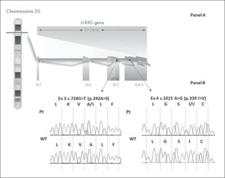 Figure 3: A schematic representation of the MKKS gene locus and mutations identifi ed (Panel A) and
chromatographs (Panel B) showing the sequence variation p.242A>S in exon 3 (left) and the sequence variation p.339I>V in exon 4 (right) in the proband (Pt) and a control subject (WT).