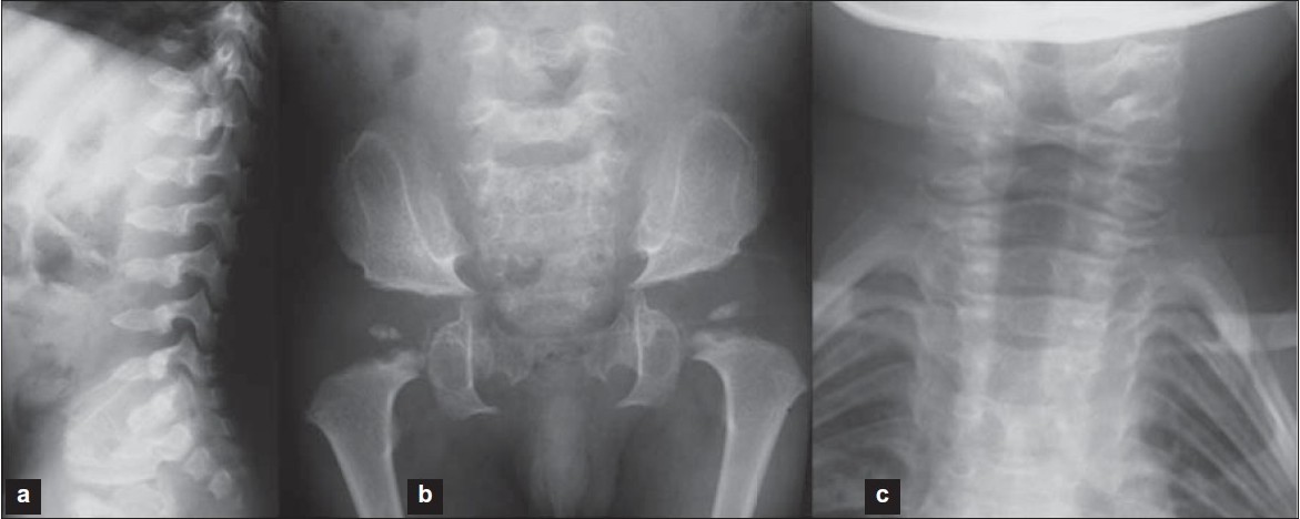 Figure 1: Radiographs of the patient. (a) spine, (b) pelvis and hip joints, (c) cervical of spine