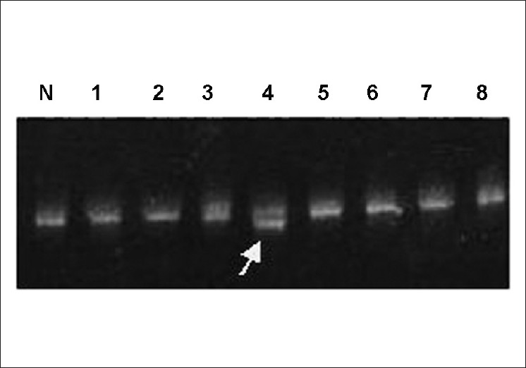 Figure 1: Part of CSGE gel showing the migration pattern of exon 14D amplified fragments. Fragments with abnormal migration patterns are marked by arrow. N: normal control and 1, 2, 3, 4 (HA11), 5, 6, 7, 8, 9 different hemophilia A patients.
