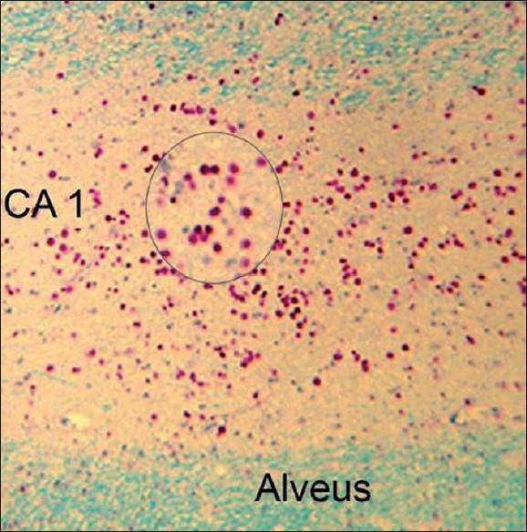 Figure 1: Microphotograph showing dense deposition of corpora amylacea (CoA) in the CA1 sector of the hippocampus in a 42-year-old male with mesial temporal lobe epilepsy and hippocampal sclerosis. Inset shows a magnifi ed view of the CoA (Luxol-fast blue– Periodic Acid Schiff stain, X150). 83 mm x 84 mm (300 x 300 DPI)