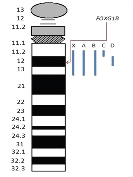 Figure 2: An ideogram of chromosome 14 showing the regions deleted in the case reports compared in Table 1. The location of FOXG1B is indicated. The blue bars indicate the regions deleted in the cases compared in Table 1. X is the baby reported in this case report