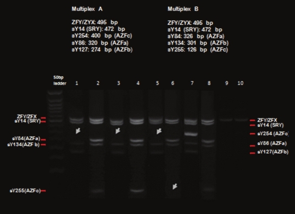 Figure 2: Gel electrophoresis profile of three azoospermic men with normal karyotype. 
 Patients K17 and K25 in lanes 1, 2 and 3, 4, respectively, with the absence of the sY254 marker, patient (K6) with the absence of the sY254 and sY255 markers, indicating a complete deletion in the AZFc sub-region in the 5<sup>th</sup> and 6<sup>th</sup> lanes where the deleted bands are marked with an arrow. A normal male in the 7<sup>th</sup> and 8<sup>th</sup> lanes and a female sample as the negative control in the 9<sup>th</sup> and the 10<sup>th</sup> lanes.
