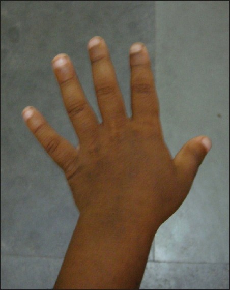 Figure 2: Short and stubby fingers, rough skin