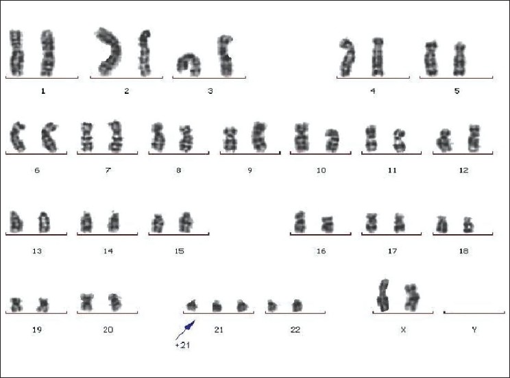 Figure 1: Karyotype 47, XX + 21 of the daughter of Triple X syndrome