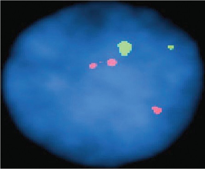 Figure 1: Patient P1 with cytogenetics 47, **+21 showing trisomy 21 with three spectrum orange signals for chromosome 21 and two spectrum green signal for chromosome 13 after doing fluorescence in situ hybridization in amniocytes nuclei