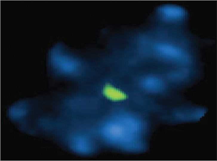 Figure 2: Patient P2 with cytogenetics karyotype showing 45* showing only one spectrum green signal for chromosome X after doing fluorescence <i>in situ</i> hybridization in amniocytes nuclei