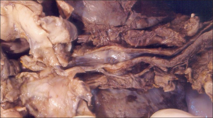 Figure 2: En block gross specimen showing the lumen of the esophagus with depressions of the bronchial openings
