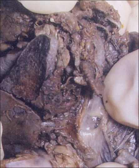 Figure 3: The esophageal lumen showing opening of one of the bronchus