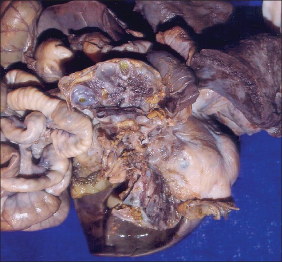 Figure 4: Gross specimen showing cystic changes of both kidneys