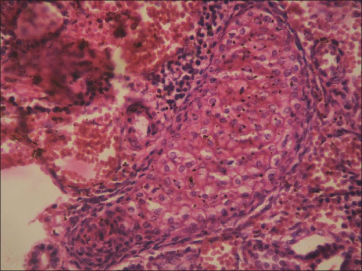 Figure 5: Photomicrograph showing cartilage in cystic renal dysplasia (H and E, ×400)