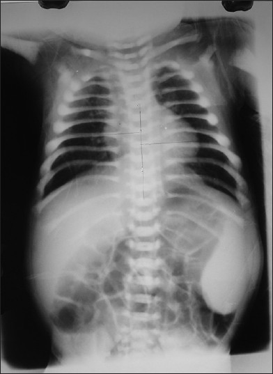 Figure 1: X-ray showing increased density in all the bones (bone in bone appearance)