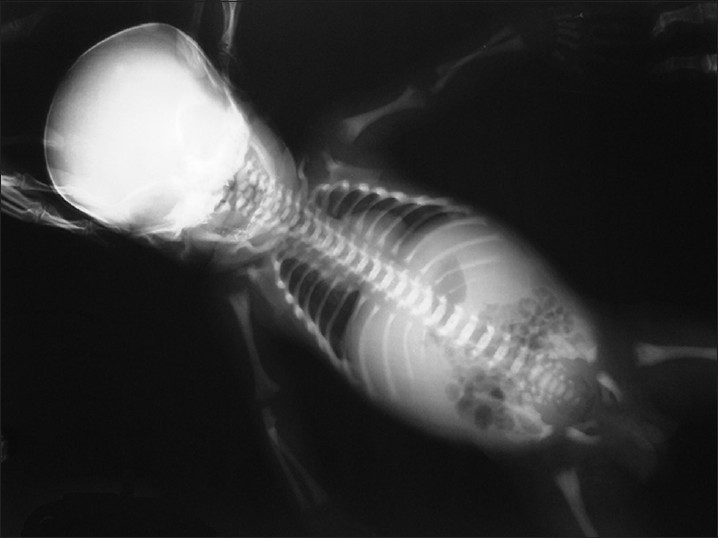 Figure 2: X-ray showing increased density in all the bones (bone in bone appearance)