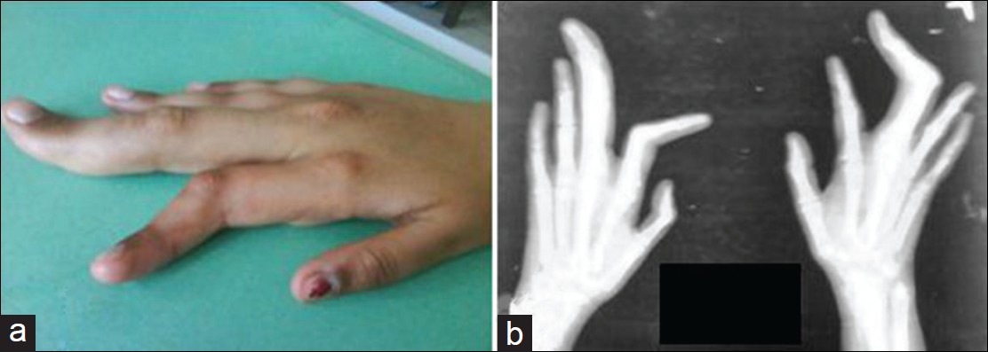 Figure 1: (a) Asymmetric and disproportionate over growth of right hand fingers with macrodactyly in a patient with Proteus syndrome; (b) X - ray of both the hands showing bony over growth in the same patient