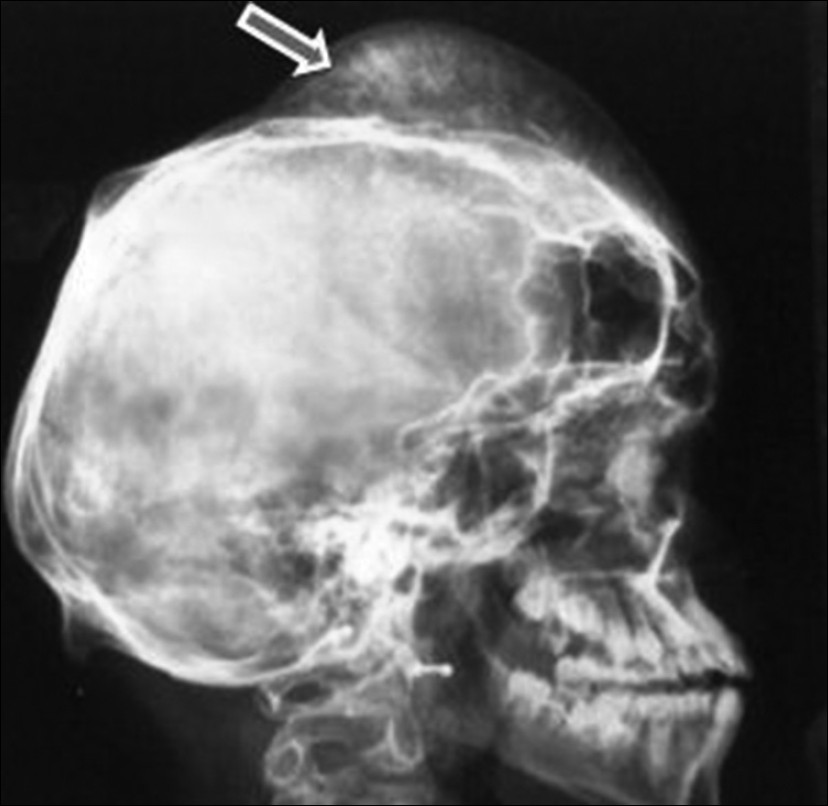 Figure 2: X - ray skull showing Hyperostotic lesion over vertex (arrow) in a girl with Proteus syndrome