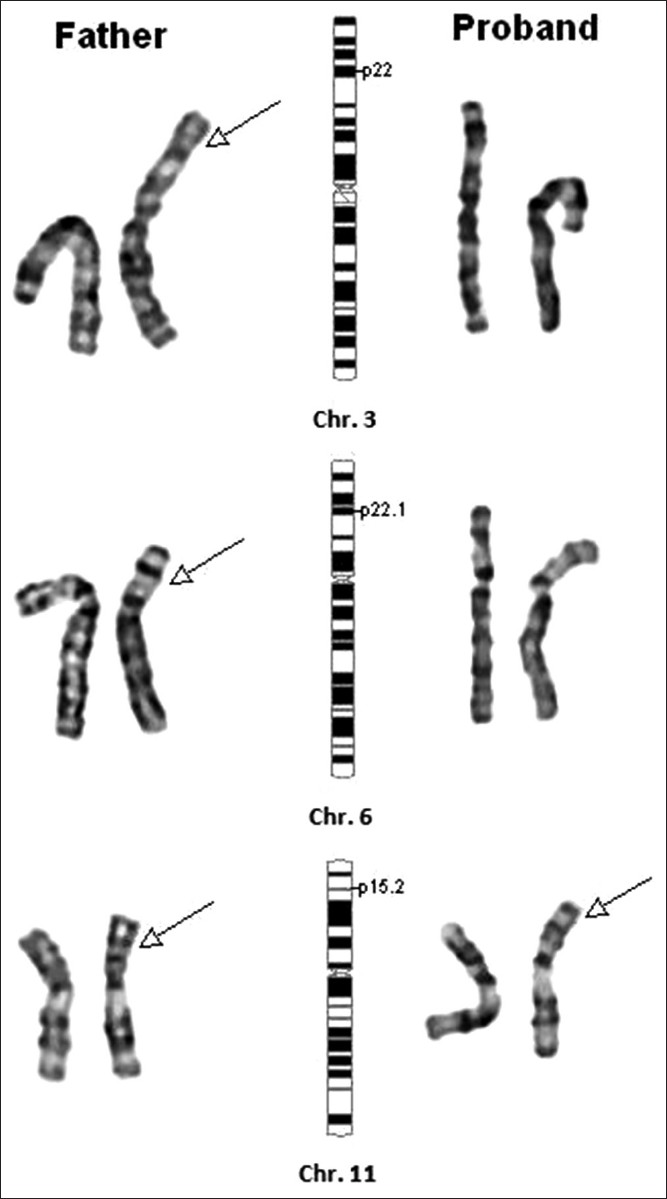 Figure 1: Partial karyotype of the proband and the father. Father: Translocation of segment on chr. 3 distal to 3p22 onto chr. 6 at band 6p22.1, translocation of the segment on chr. 6 distal to 6p22.1 onto chr. 11 at 11p15.2 and translocation of the segment on chromosome 11 distal to 11q15.2 onto chr. 3 at 3p22. Proband: Direct transmission of derivative chr. 11 containing the segment of chr. 6 from father resulting in unbalanced karyotype - partial 6p22.1 - pter and partial Monosomy 11p15.2-11pter