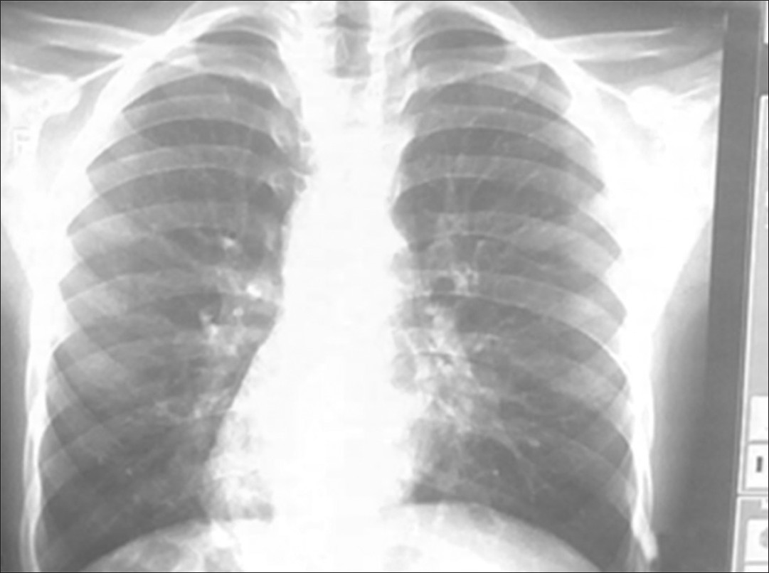 Figure 1: Chest X - Ray Showing Dextrocardia