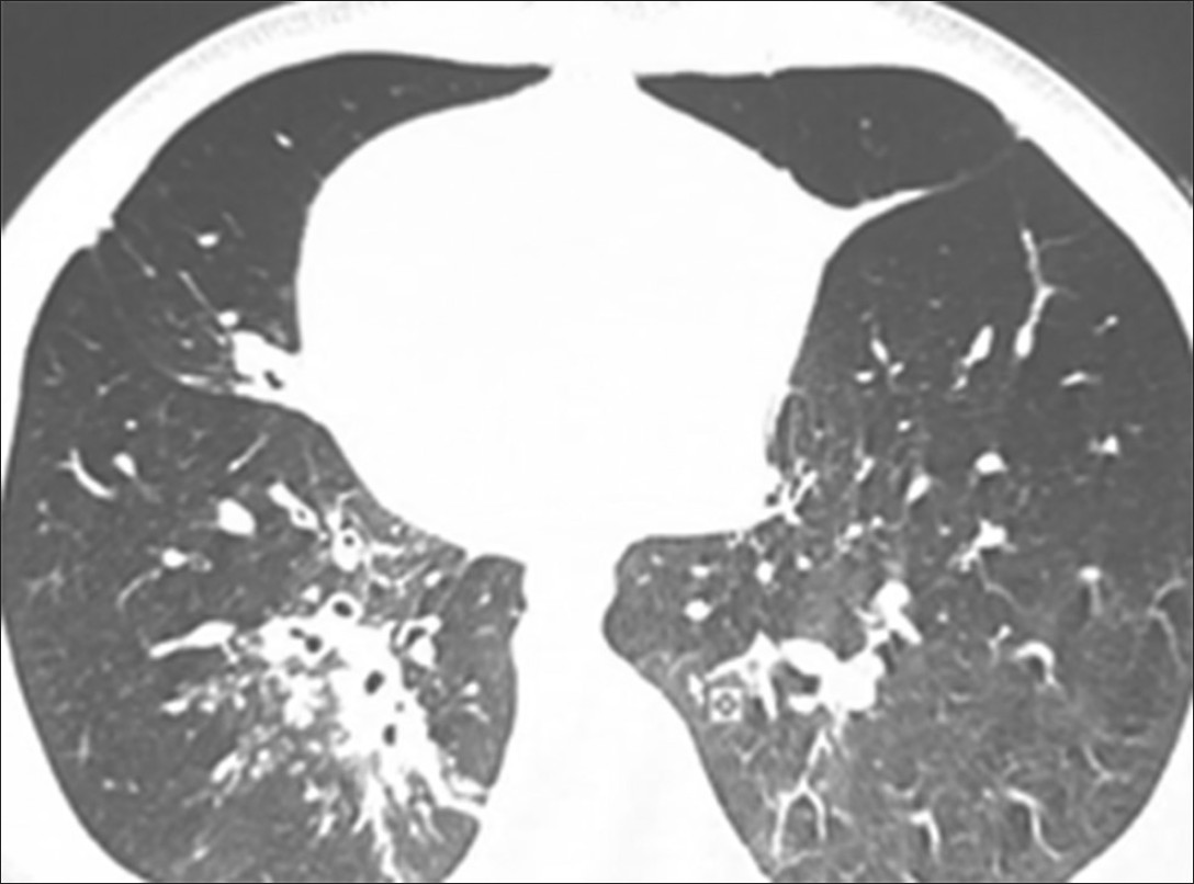 Figure 3: Computed tomography showing bronchiectasis