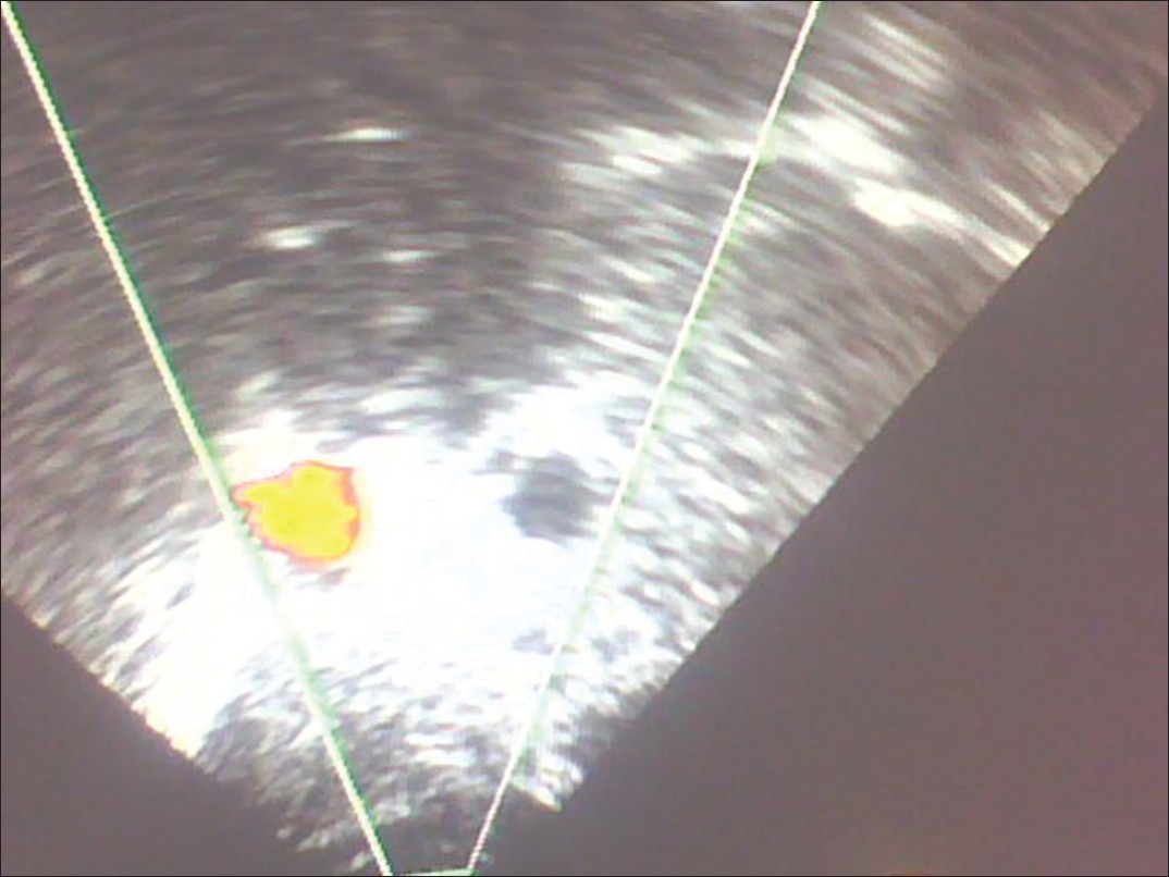 Figure 4: Color Doppler showing transposition of the aorta and IVC