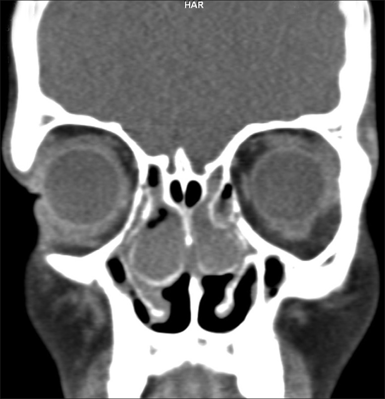 Figure 5: Computed tomography PNS (coronal cut) showing fused bulla with uncinate process