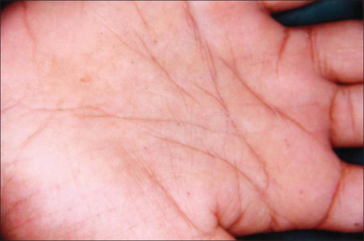 Figure 1: Multiple palmar pits on the hand