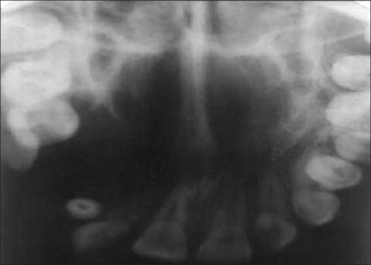 Figure 2: Anterior maxillary occlusal view