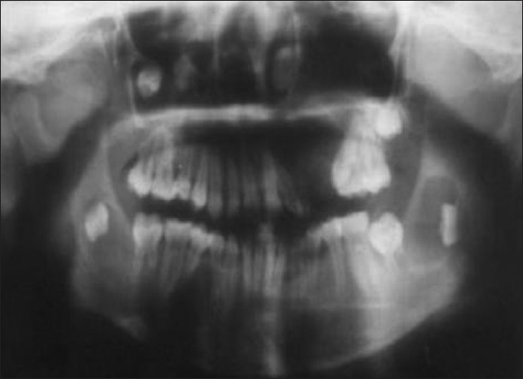 Figure 3: Orthopantomograph showing multiple jaw cysts in relation to impacted and unerupted teeth