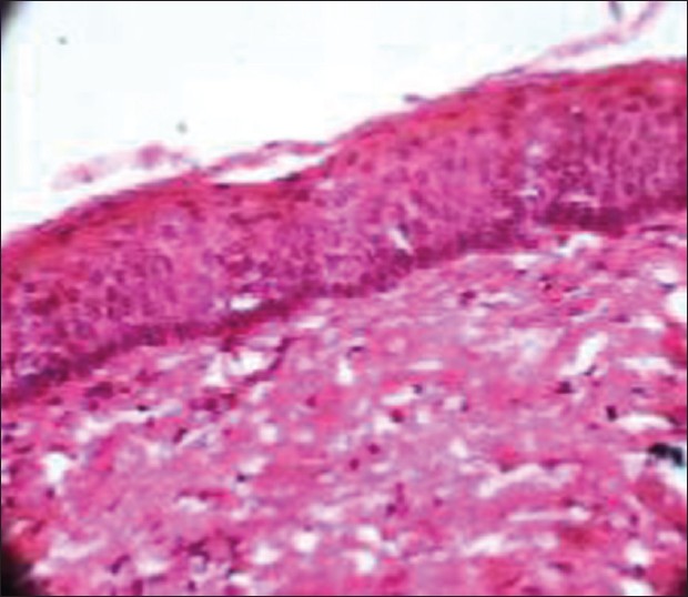 Figure 4: Histological section showing stratified squamous parakeratinized epithelium with palisading pattern of columnar cells along with keratin flakes suggestive of odontogenic keratocyst under high power (×40)