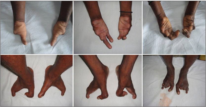 Figure 1: Mother and two siblings with s plit-hand/foot malformation (SHFM)