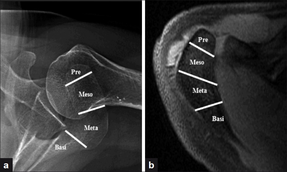 Figure 1: (a) Axillary radiograph; (b) Axial magnetic resonance image. (Pre - Preacromiale; Meso - Mesoacromiale; Meta - Metaacromiale; Basi - Basiacromiale)