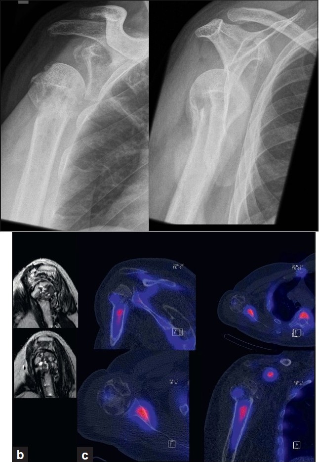 Figure 1: (a)Anterior-posterior and y-view radiographs of the right shoulder at initial presentation indicating a valgus-impacted humeral head fragment and doubtful partial osteonecrosis of the humeral head
Figure 1: (b) MRI showing extensive cystic changes within the humeral head; (c) 99mTc-HDP-SPECT/CT showing decreased uptake of the humeral head fragment indicating a humeral head necrosis