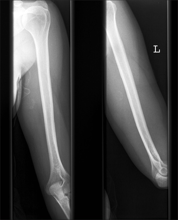 Figure 1: Anteroposterior and lateral X-ray at first presentation showing that the lesion is located posteromedially of the midshaft of the upper arm. The lesion is characterized by a sharply demarcated and partially mineralized periphery