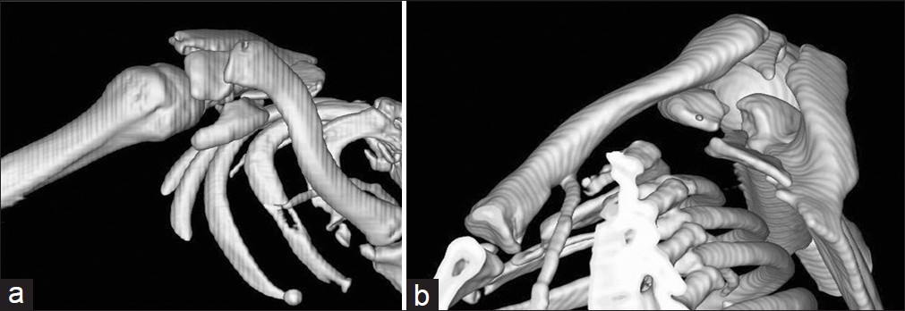 Figure 2: Preoperative 3D CT images: Anterior view (a) and medial view (b)