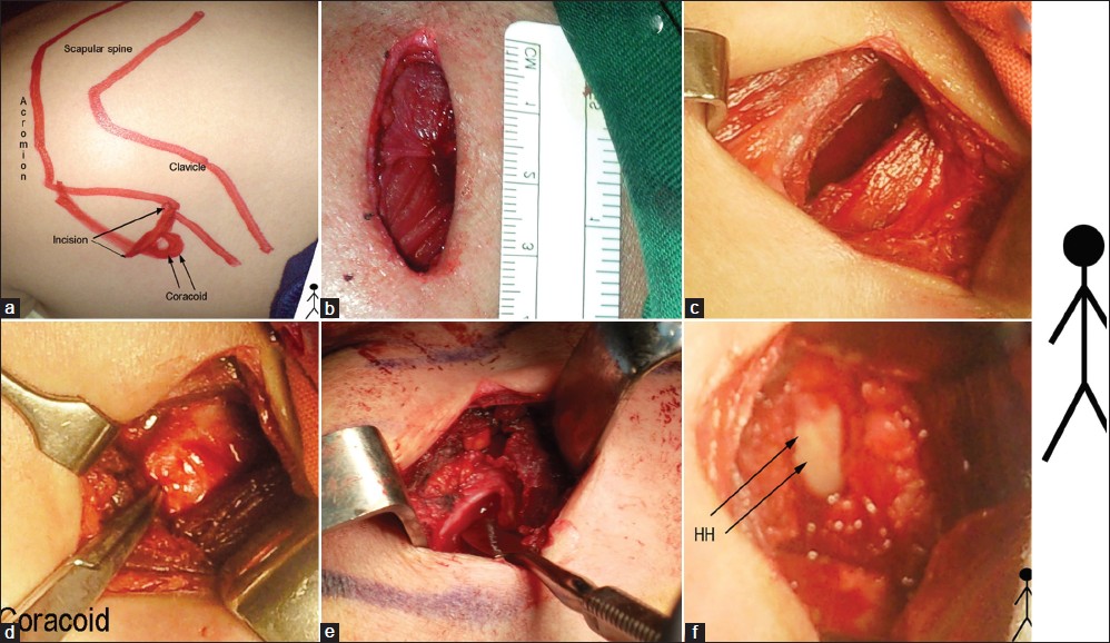Figure 1: Intraoperative photos of the surgical technique (This is the Right shoulder, head, and feet of the patient indicated by the stick figure to the right of the figure) (a) Outline of the bony landmarks and the incision. (b) The 3 cm incision. (c) The deltopectoral interval. (d) The coracoid. (e) Dissector under the CHL (f) Capsulotomy performed and the Humeral Head (HH) shown