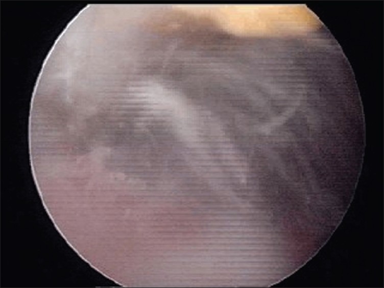 Figure 1: Typical white cloud appearance of the subacromial space after excision of the calcific deposits from the tendon