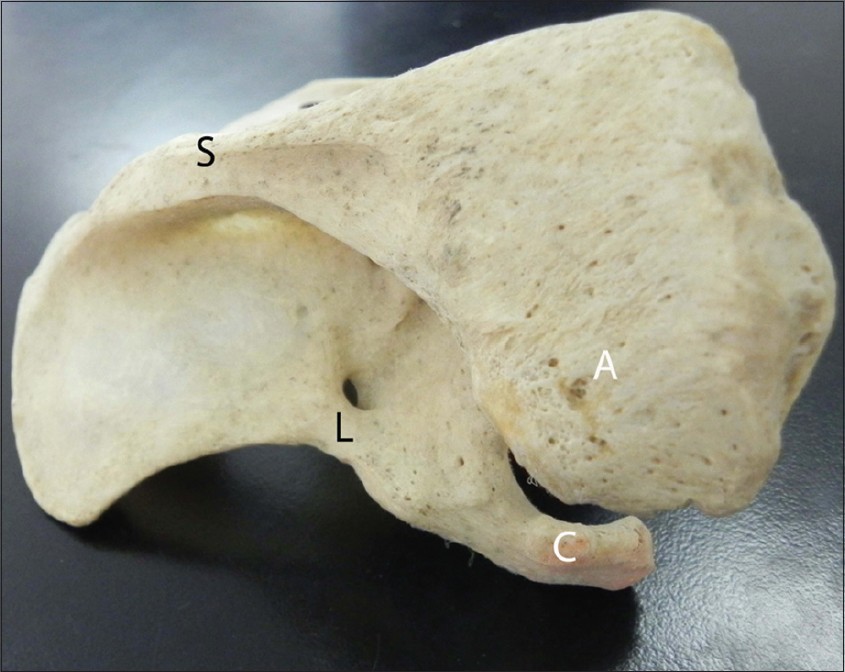 Figure 1: Example of the left scapula with ossified suprascapular ligament (L) resulting in the foramen scapulae (seen above the L). For reference, note the spine (S), coracoid process (C) and acromion
(A) of the scapula